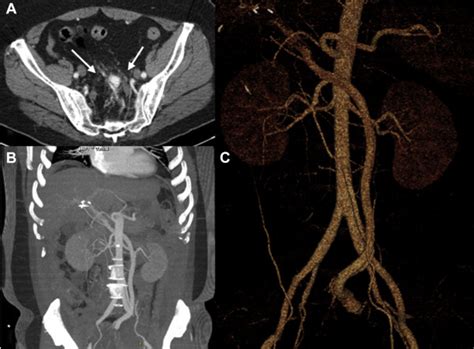 Spontaneous inferior mesenteric arteriovenous fistula as a cause .